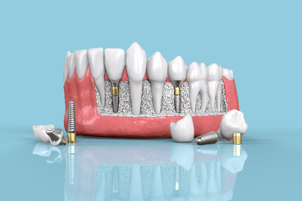 Dental Implants