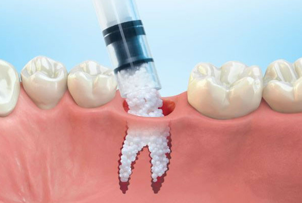 Bone Grafting