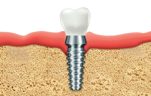 Dental implants and how crucial replacing teeth really is