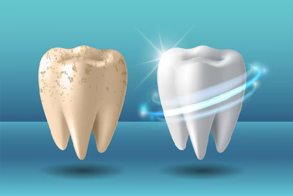 Common Symptoms of Tooth Decay